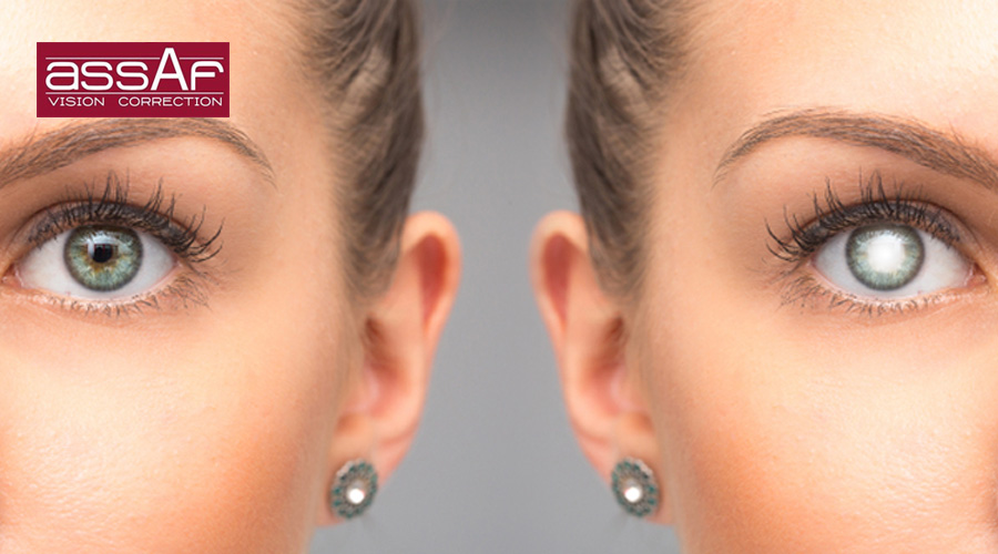 Cataract surgery success rate
